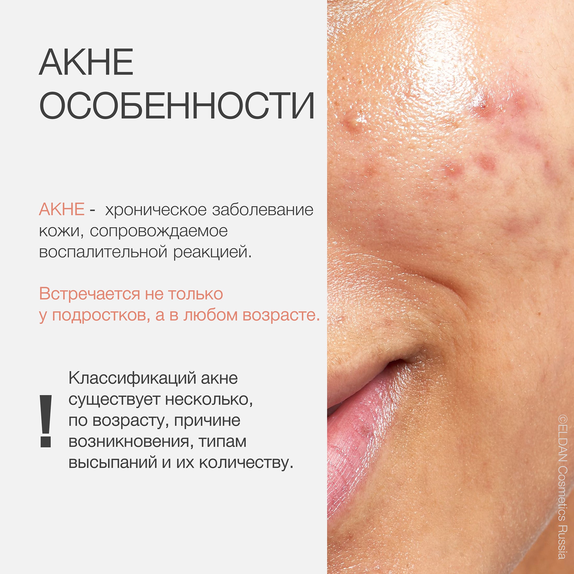 Пост виды акне 2.jpg